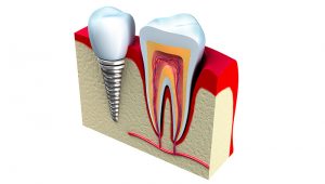 Implantes dentales en Huesca Alins Clinica Dental
