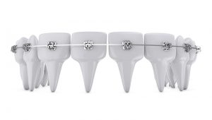 Ortodoncia en huesca Alins Clinica Dental