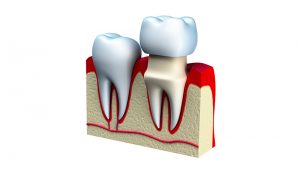 Prostodoncia en Huesca Alins Clinica Dental